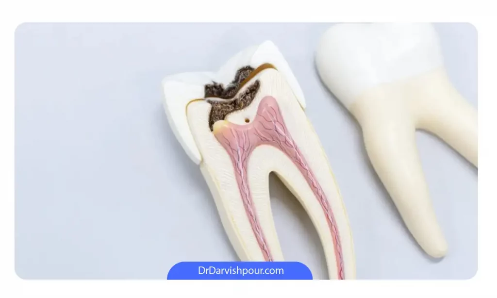 پوسیدگی دندان