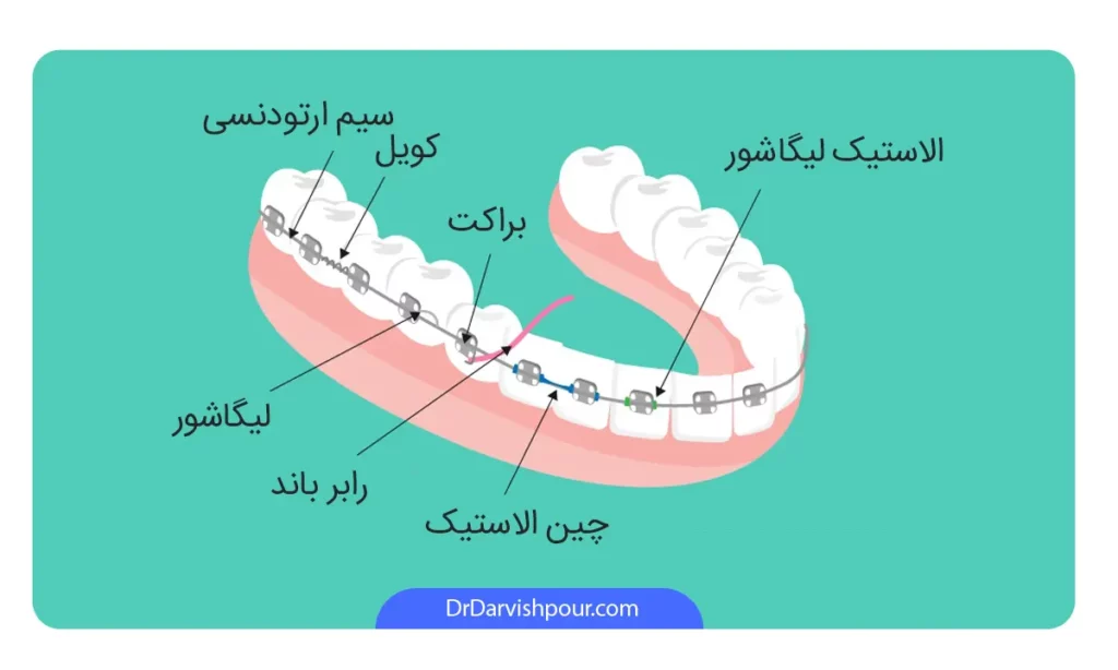 اینفوگرافی اجزای مختلف ارتودنسی ثابت