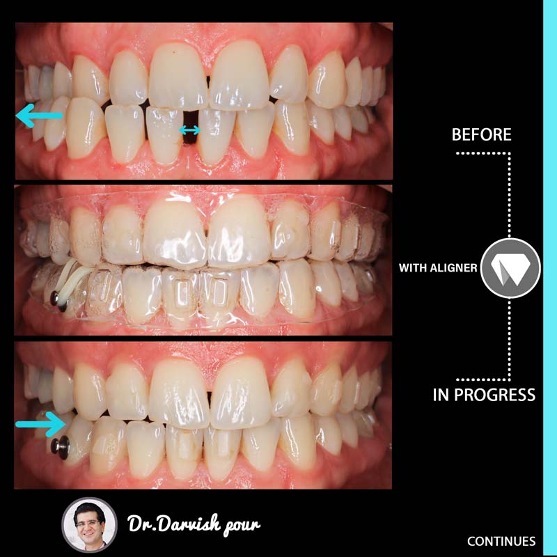 مراحل درمان ارتودنسی نامرئی با الاینرها از ابتدا تا آخر درمان مربوط به یکی از بیماران دکتر درویش پور