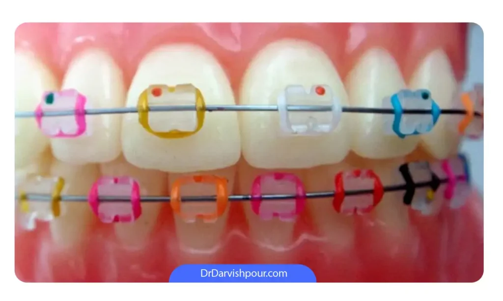 اورینگ های ارتودنسی در چند رنگ مختلف