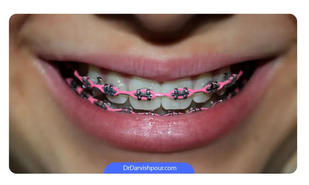 اوردنسی رنگی با زنجیرها یا چین های صورتی