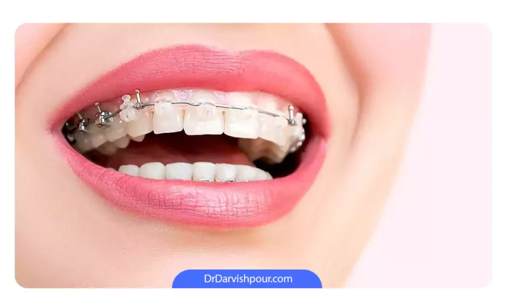 ارتودنسی سرامیکی بدون کش