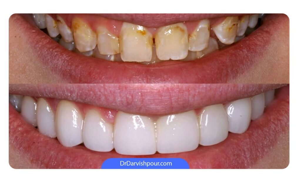 قبل و بعد از لمینت دندان