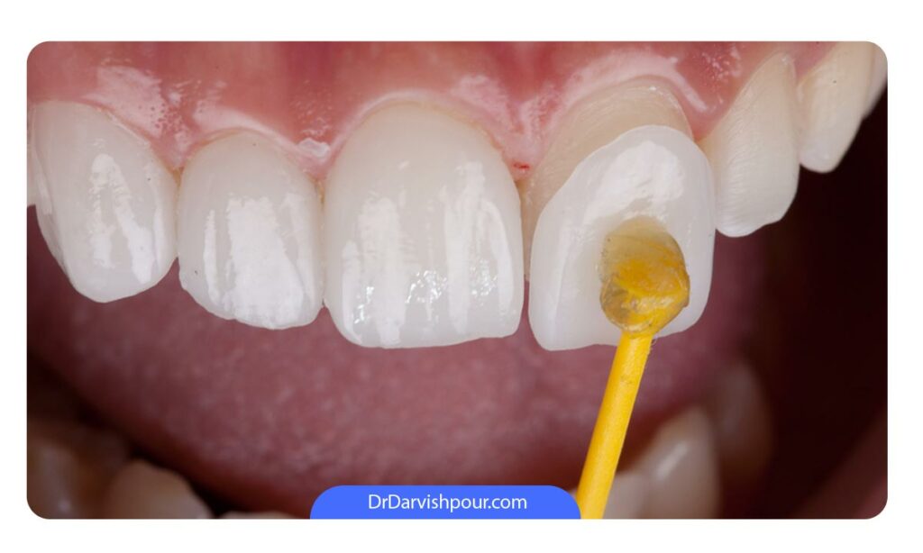 عکس لمینت دندان در حال اتصال به سطح جلویی دندان