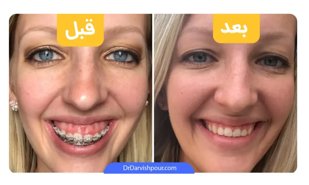 عکس قبل و بعد اصلاح لبخند لثه ای