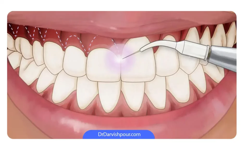 اصلاح لبخند لثه ای با لیزر