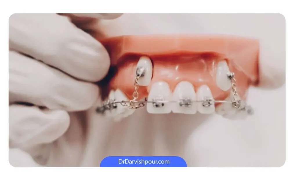 ارتودنسی دندان های نیش به صورت شماتیک