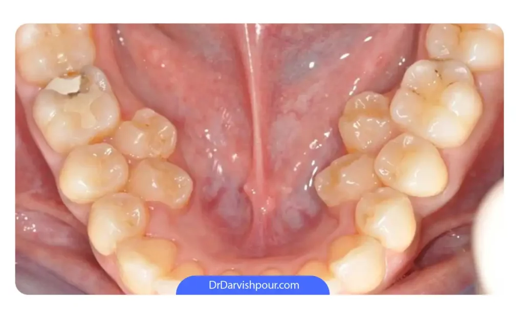 دندان های اضافی در هر طرف فک پایین