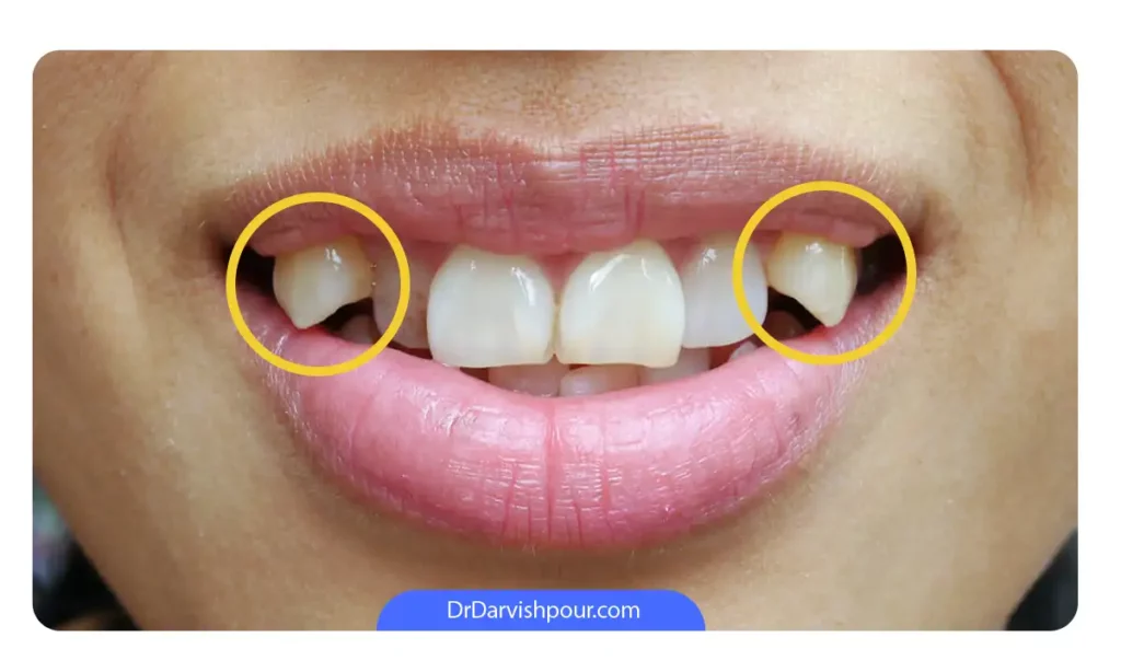 دندان های نیش بیرون زده در یک دختر نوجوان