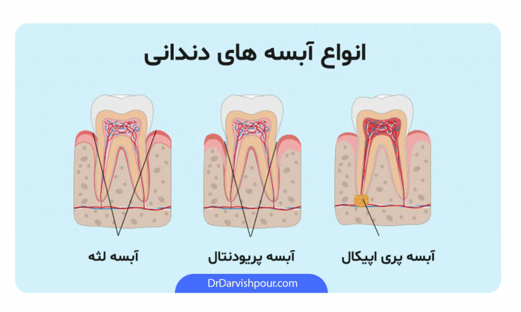 اینفوگرافی انواع آبسه دندان