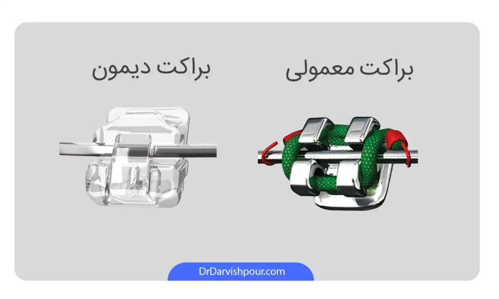 تفاوت براکت معمولی با براکت ارتودنسی دیمون