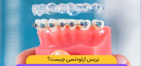 عکس بریس ارتودنسی