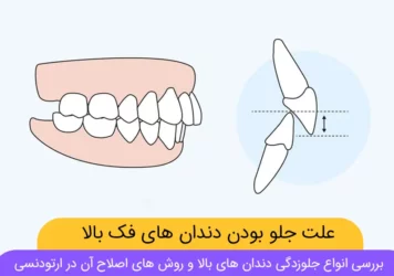 عکس جلوزدگی دندان های بالا (شماتیک)