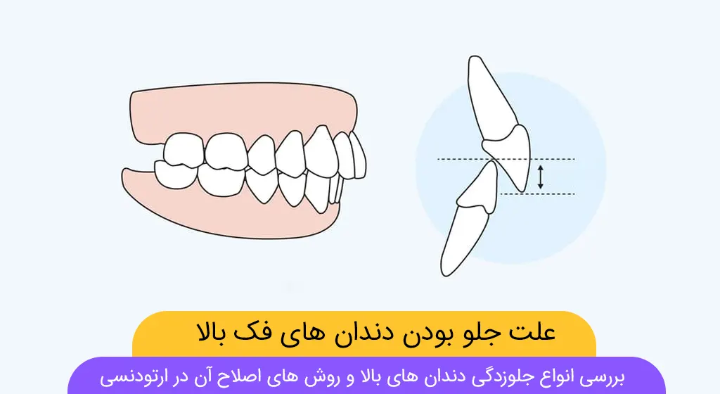 عکس جلوزدگی دندان های بالا (شماتیک)