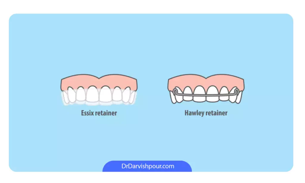 تصویر شماتیک انواع نگهدارنده ارتودنسی