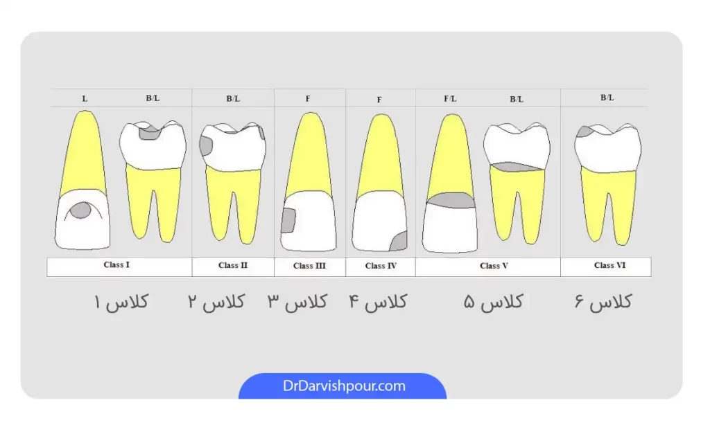 عکس کلاس بندی پوسیدگی دندان