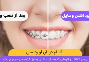 اتمام درمان ارتودنسی و برداشتن وسایل ارتودنسی