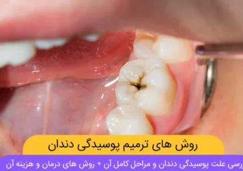 عکس پوسیدگی دندان