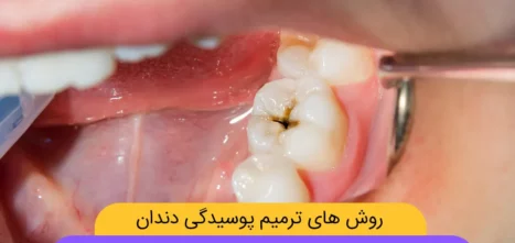 عکس پوسیدگی دندان