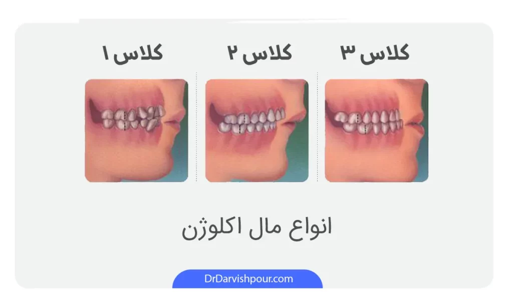 انواع ناهنجاری ها که با ارتودنسی بزرگسالان برطرف می شود