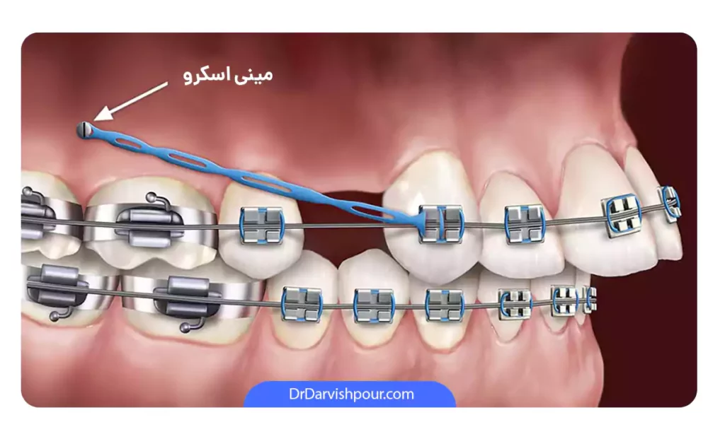 عکس مینی اسکرو به صورت شماتیک برای برطرف کردن اورجت