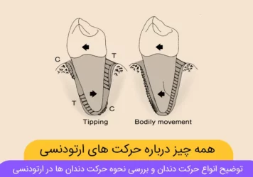 حرکت دندان ها در ارتودنسی - حرکت ارتودنسی