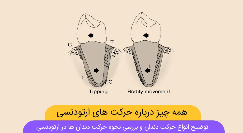 حرکت دندان ها در ارتودنسی - حرکت ارتودنسی