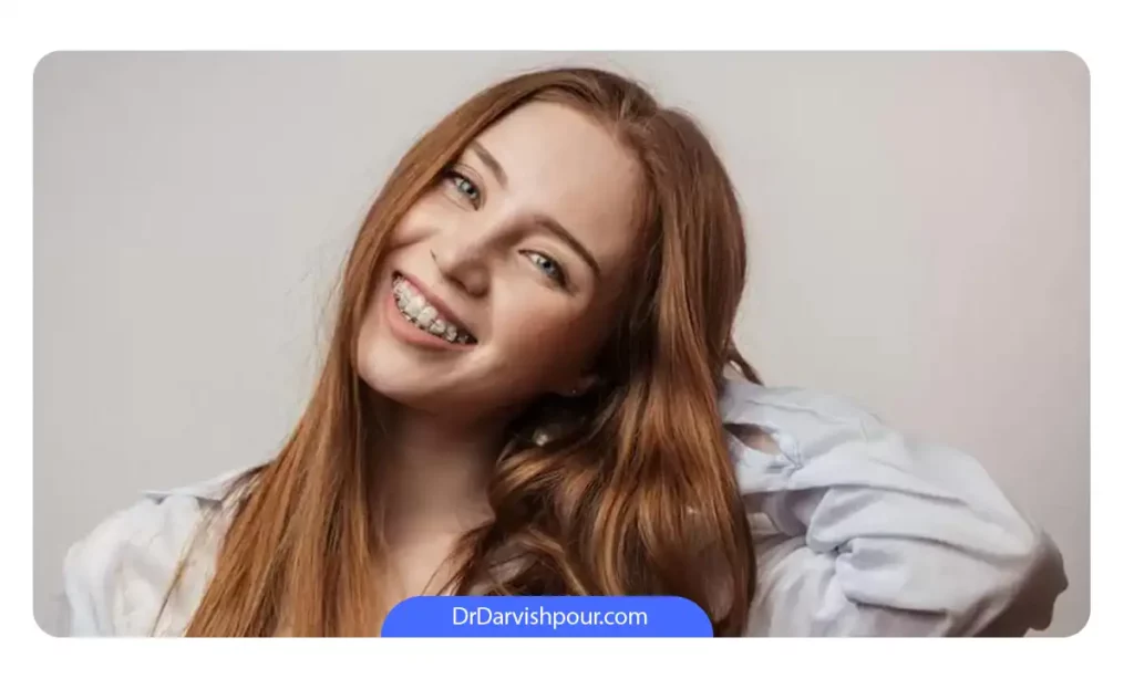 خانمی که ارتودنسی سرامیکی دارد