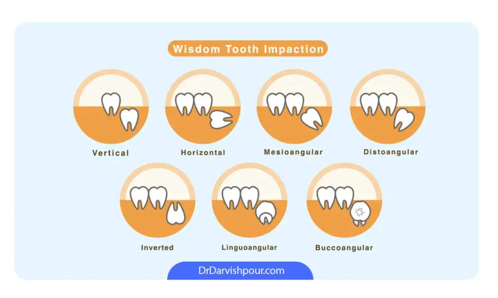 وضعیت های مختلف نهتفگی دندان که باعث دندان در می شود