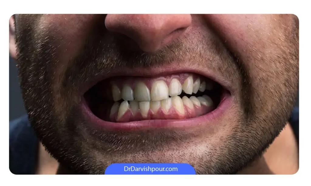 مردی که دندان قروچه و تحلیل لثه را با هم تجربه می کند