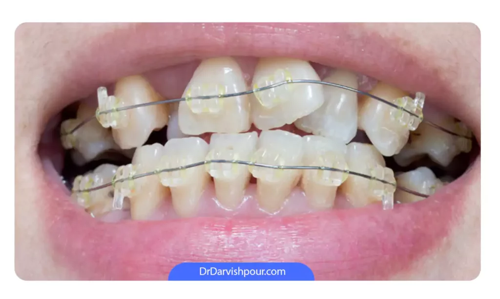 مزایای ارتودنسی دندان با پیشگیری از کج در آمدن دندان ها