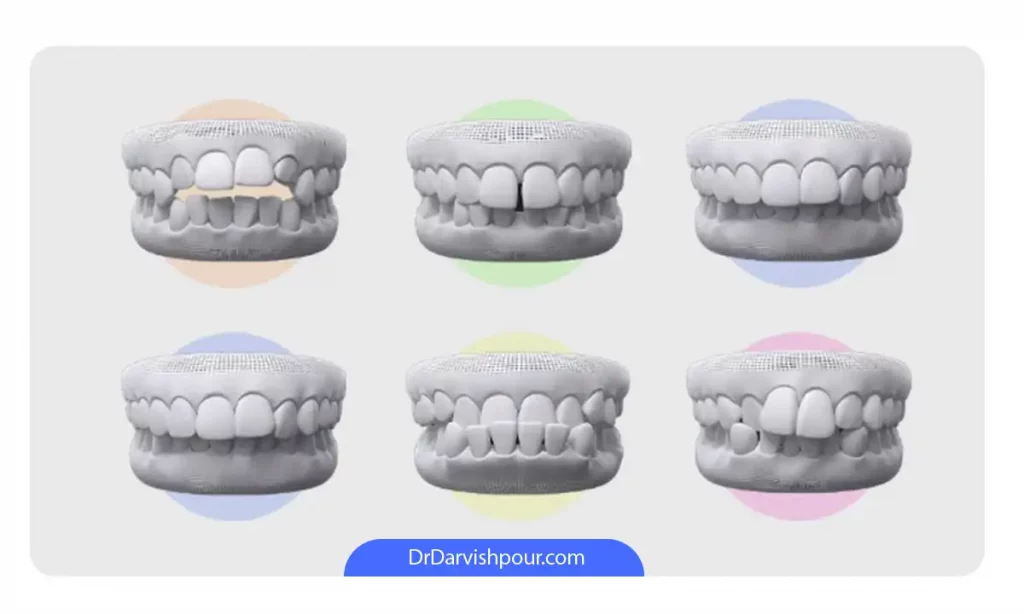 مزایای ارتودنسی دندان ها در رفع انواع ناهنجاری های دندانی