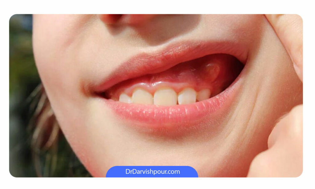 آبسه دندان در یک دختر خانم که به صورت دندان درد احساس می شود
