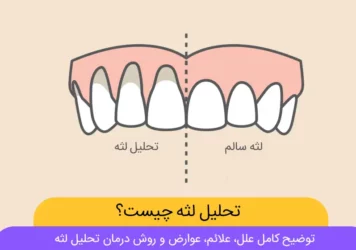 تحلیل لثه یا عقب نشینی لثه