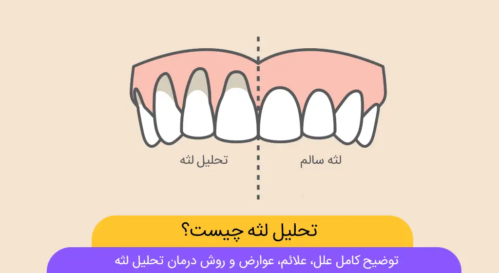 تحلیل لثه یا عقب نشینی لثه