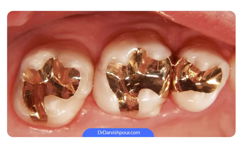 عکس پر کردن دندان با طلا