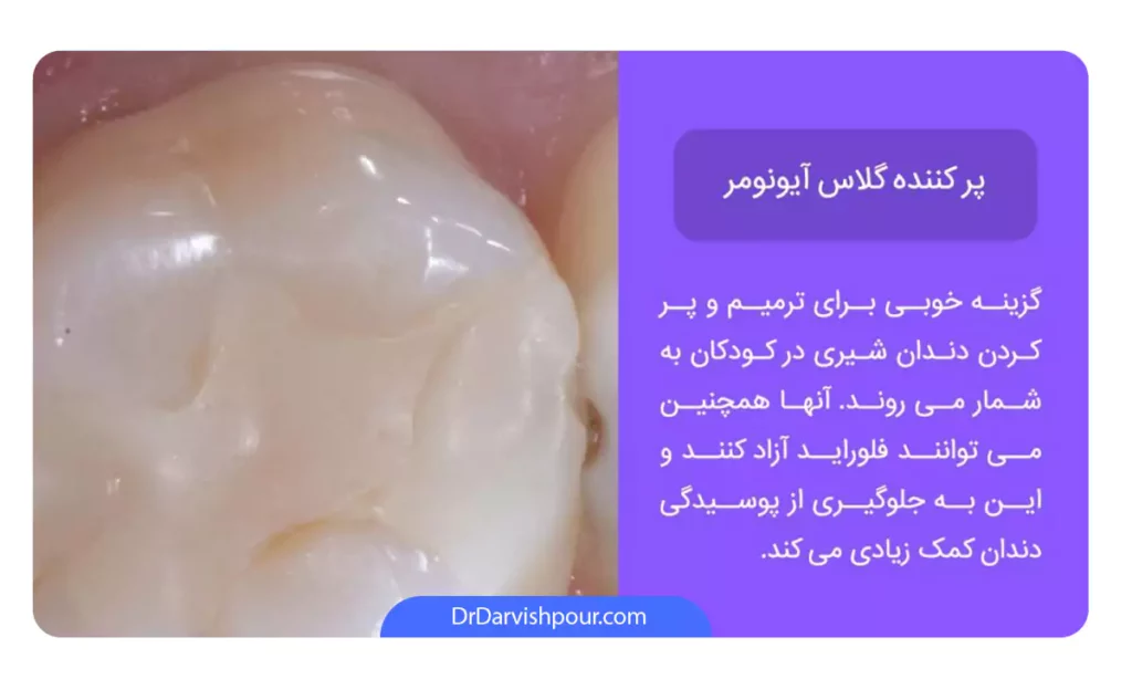 اینفوگرافی پر کردگی دندان از جنس گلاس آیونومر