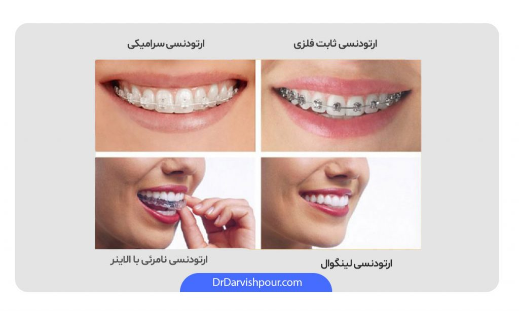 اشکال مختلف ارتودنسی دندان
