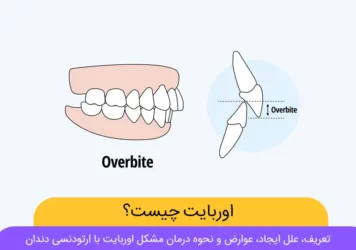 عکس اوربایت دندان ها