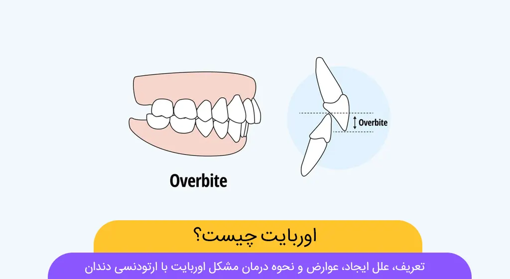 عکس اوربایت دندان ها