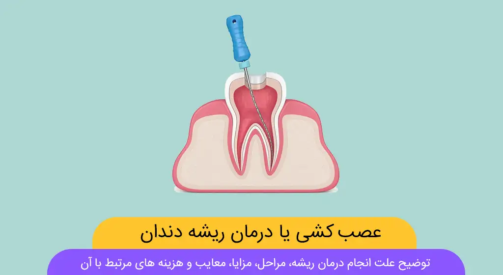 عصب کشی دندان عکس