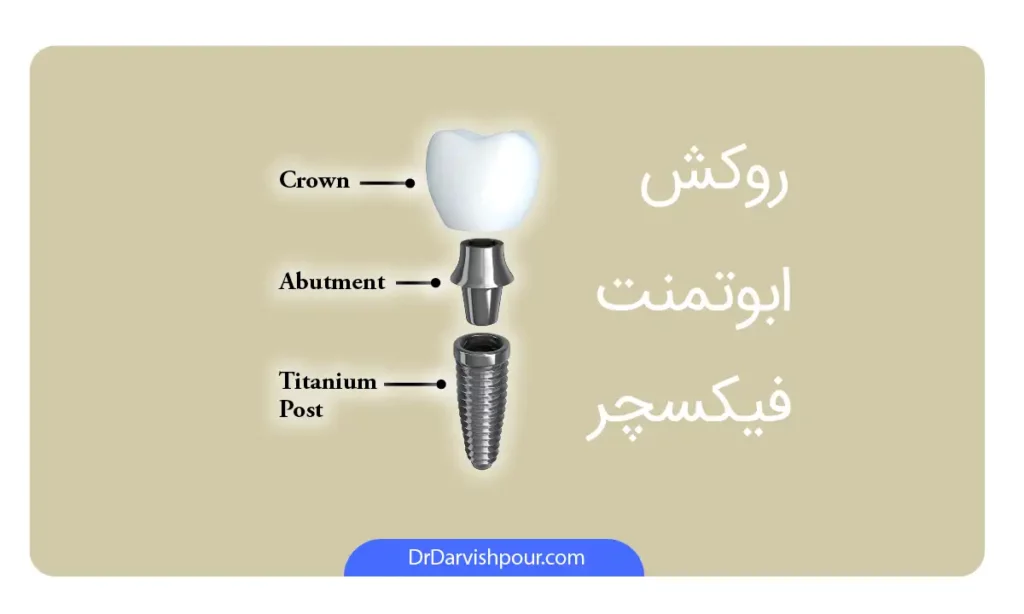 اینفوگرافی اجزای مختلف ایمپلنت دندان