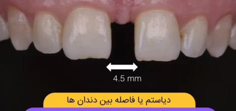 فاصله بین دندان ها