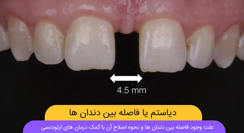 فاصله بین دندان ها