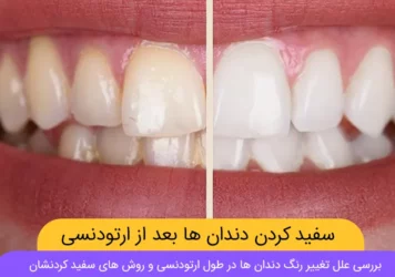 سفید کردن دندان ها بعد از ارتودنسی
