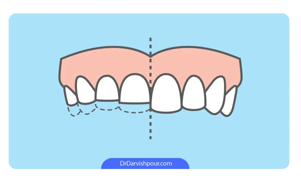 تحلیل مینای دندان به عنوان یکی از عوارض دندان قروچه