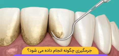 جرمگیری دندان