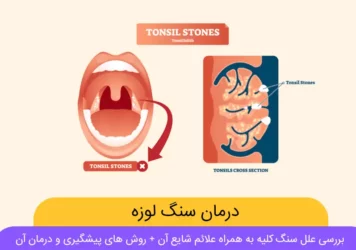 درمان سنگ لوزه چیست