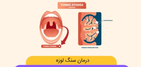 درمان سنگ لوزه چیست
