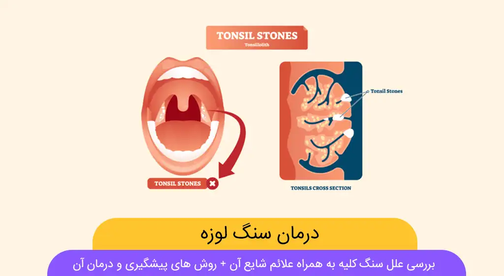 درمان سنگ لوزه چیست